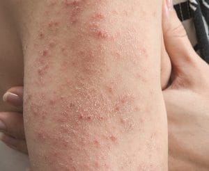 Celiac rash,